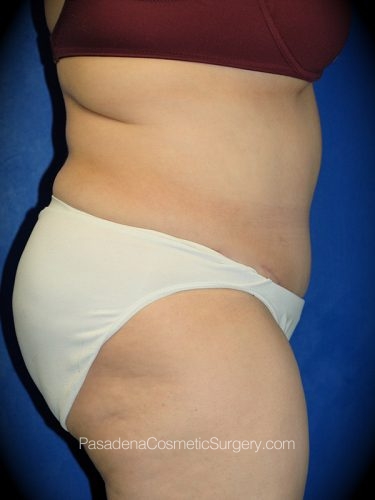 Tummy Tuck Patient 08 After - 2