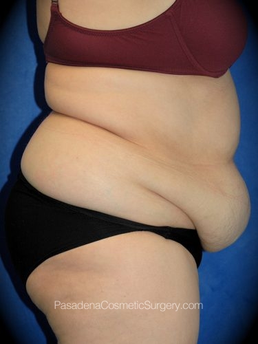 Tummy Tuck Patient 08 Before - 2