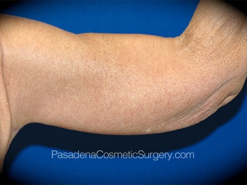 Arm Lift Patient 10 After - 2