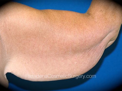 Arm Lift Patient 10 Before - 2