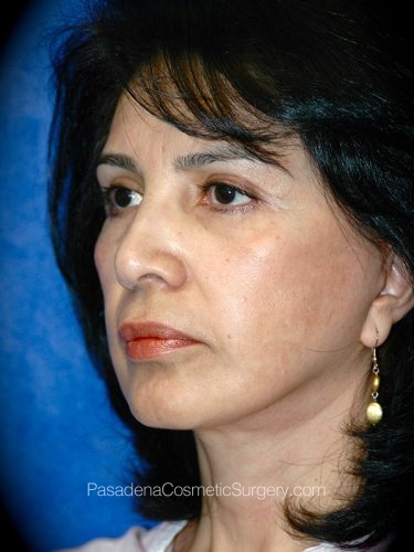 Facelift Patient 13 After - 2