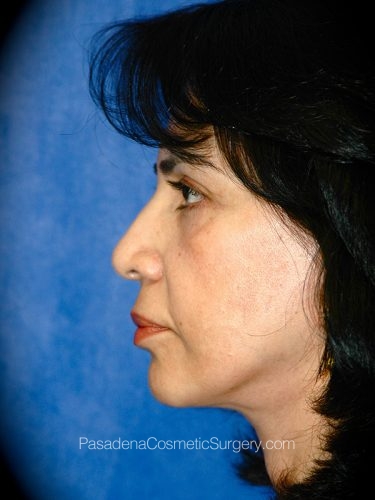 Facelift Patient 13 After - 3