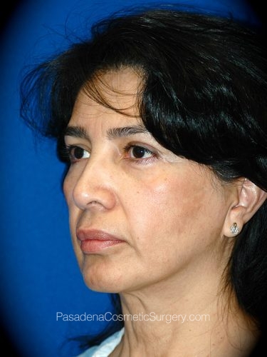 Facelift Patient 13 Before - 2