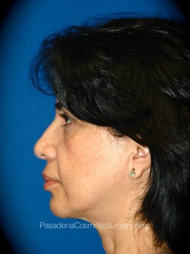 Facelift Patient 13 Before - 3