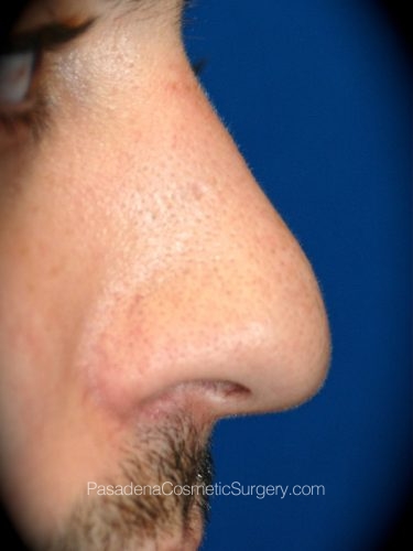 Rhinoplasty Patient 07 After - 2
