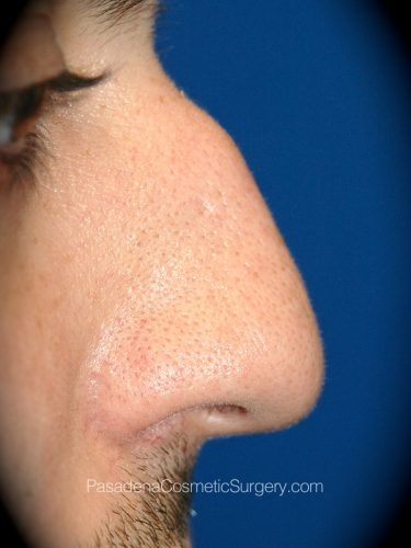 Rhinoplasty Patient 07 Before - 2