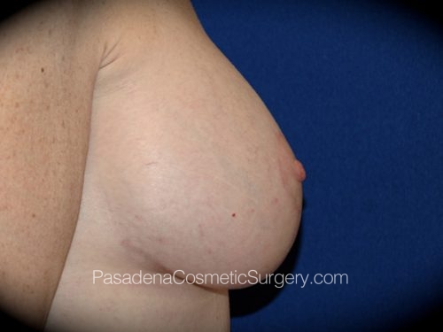 Breast Augmentation with Mastopexy Patient 06 After - 3