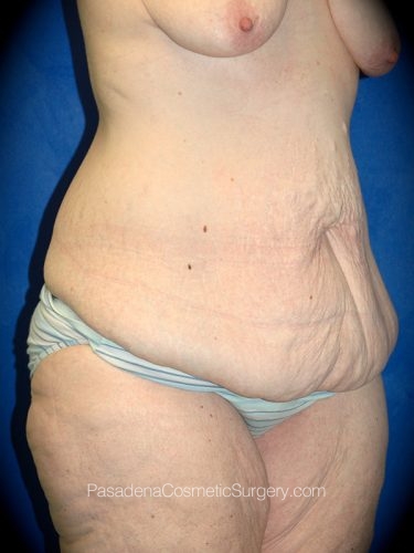 Body Lift Patient 03 Before - 2