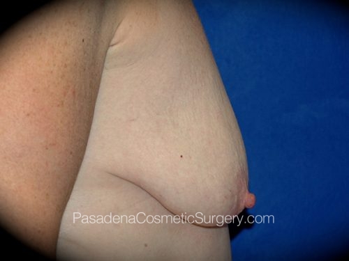 Breast Augmentation with Mastopexy Patient 06 Before - 3