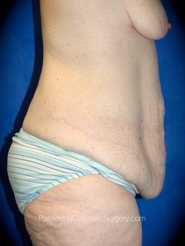 Body Lift Patient 03 Before - 3