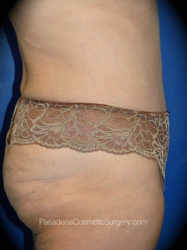 Tummy Tuck Patient 09 After