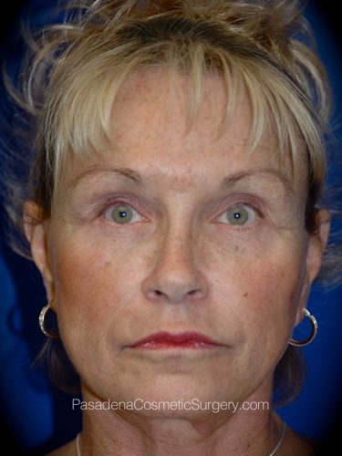 Facelift Patient 14 After