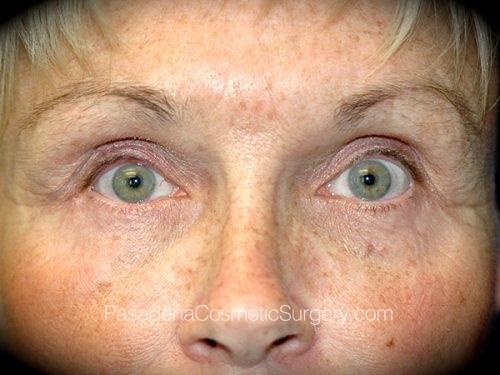 Eyelid Surgery Patient 19 After