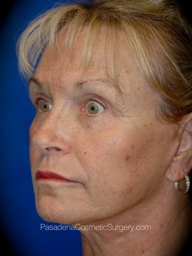 Facelift Patient 14 After - 2