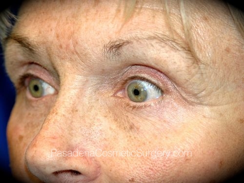 Eyelid Surgery Patient 19 After - 2