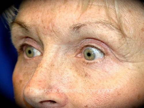 Brow Lift Patient 05 After - 2