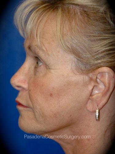 Facelift Patient 14 After - 3