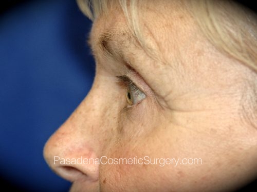 Eyelid Surgery Patient 19 After - 3