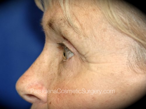 Brow Lift Patient 05 After - 3