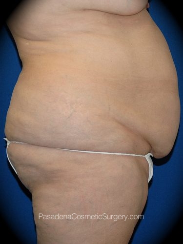 Tummy Tuck Patient 09 Before