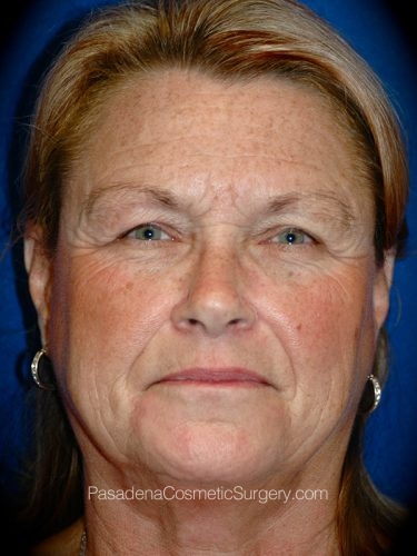 Facelift Patient 14 Before