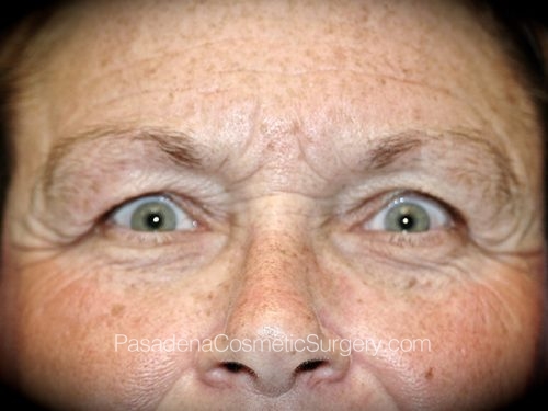 Eyelid Surgery Patient 19 Before