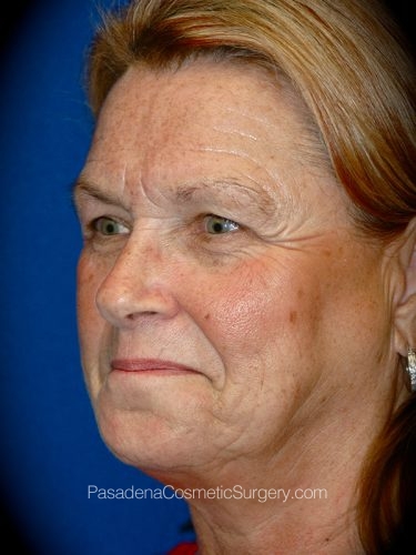 Facelift Patient 14 Before - 2