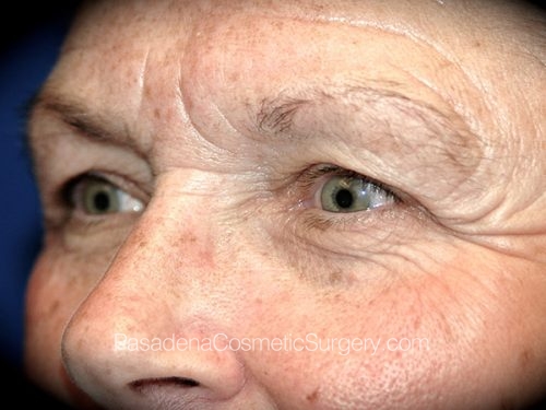 Eyelid Surgery Patient 19 Before - 2