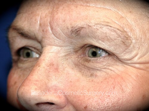 Brow Lift Patient 05 Before - 2