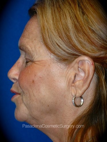 Facelift Patient 14 Before - 3