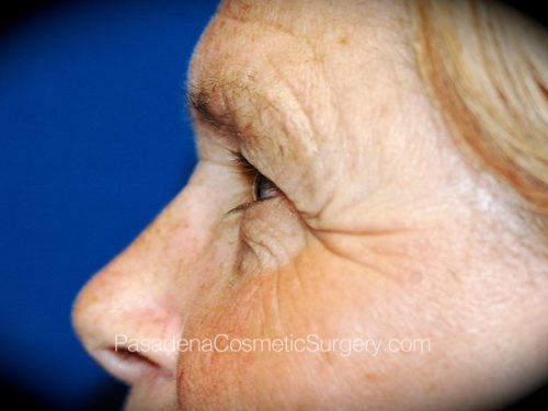 Eyelid Surgery Patient 19 Before - 3