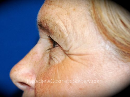 Brow Lift Patient 05 Before - 3