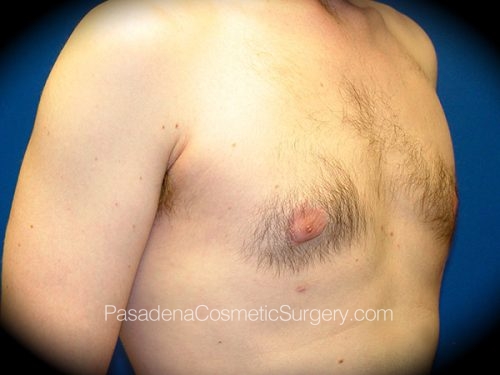 Gynecomastia Patient 01 After - 2