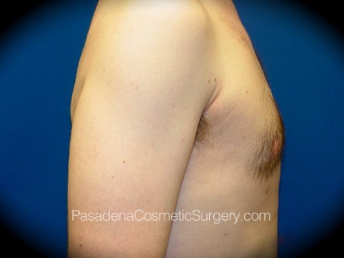 Gynecomastia Patient 01 After - 3