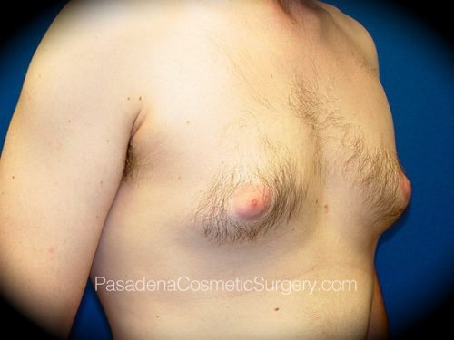 Gynecomastia Patient 01 Before - 2