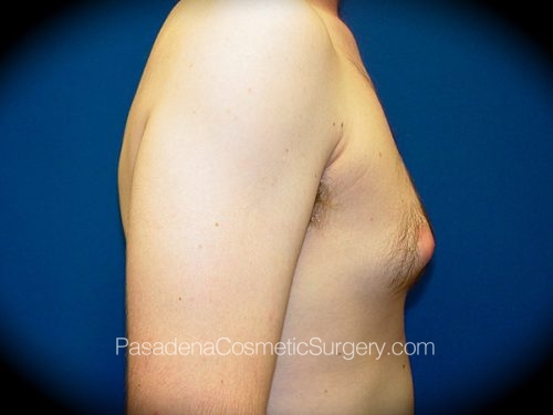 Gynecomastia Patient 01 Before - 3