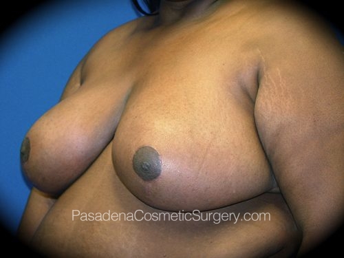 Breast Reduction Patient 02 After - 2