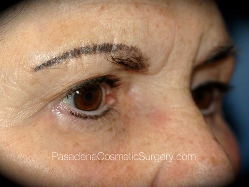 Eyelid Surgery Patient 20 After