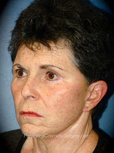 Facelift Patient 15 After - 2