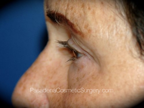 Eyelid Surgery Patient 20 After - 2