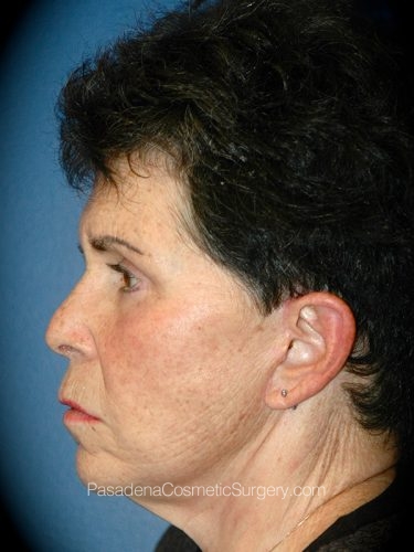 Facelift Patient 15 After - 3