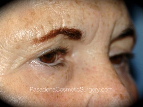 Eyelid Surgery Patient 20 Before