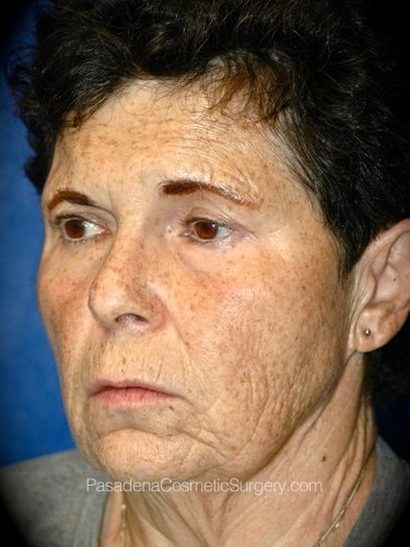 Facelift Patient 15 Before - 2