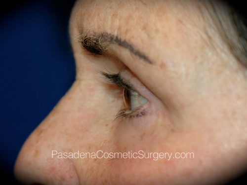 Eyelid Surgery Patient 20 Before - 2