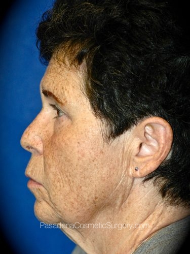 Facelift Patient 15 Before - 3