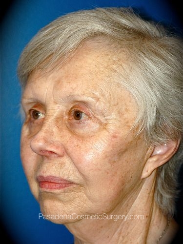 Facelift Patient 16 After - 2