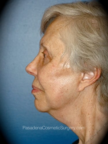 Facelift Patient 16 After - 3