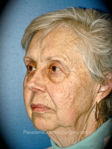 Facelift Patient 16 Before - 2