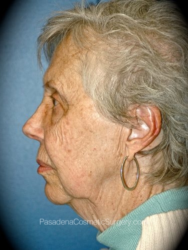 Facelift Patient 16 Before - 3
