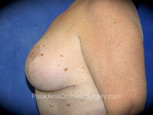 Breast Reduction Patient 05 After - 2